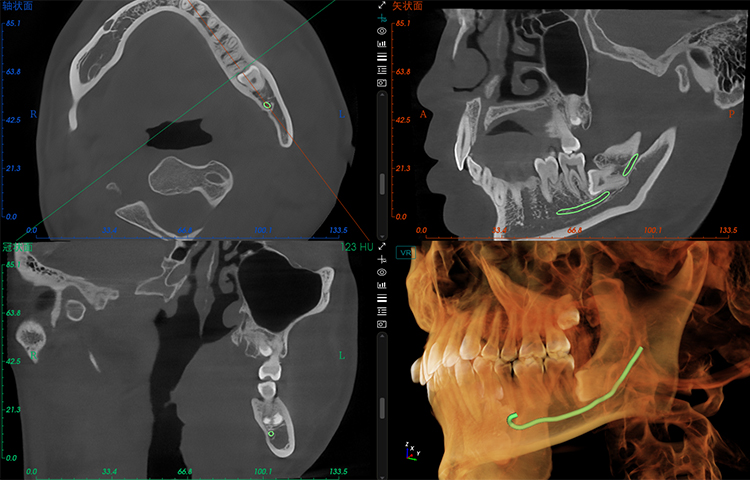 Взаимосвязь между зубами мудрости и соседними зубами